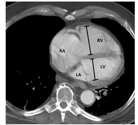 lv rv ratio radiology|rv lv ratio meaning.